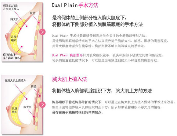 隆胸手术