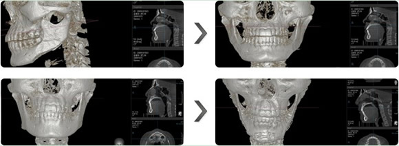 3D立体四方脸矫正术