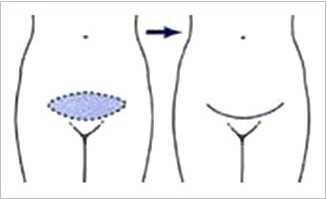迷你腹部整形术手术方法
