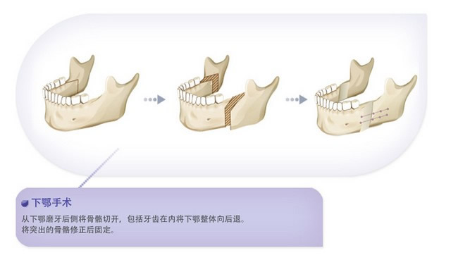 两鄂手术示意图