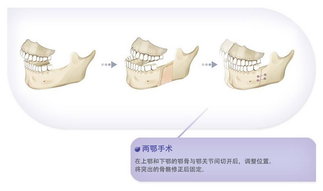 两鄂手术示意图