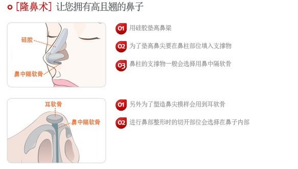 鼻部综合整形示意图