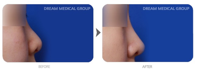 鼻部综合整形手术对比图