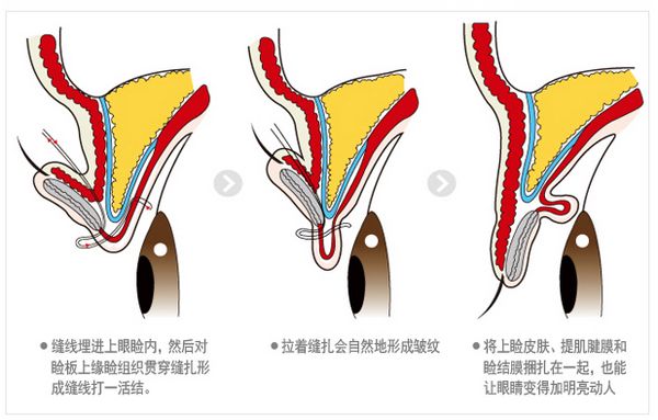 非切开式眼形矫正术方法示意图