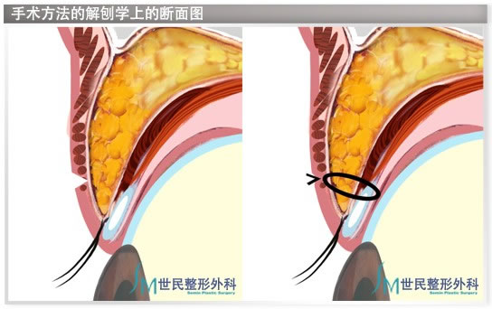 手术方法的解剖学上的断面图