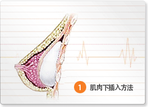 隆胸手术