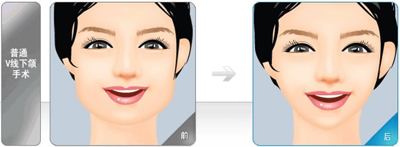 四方脸矫正整形术