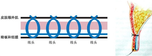 无痕双眼皮手术