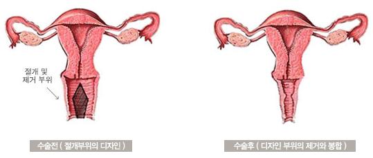 阴道整形手术