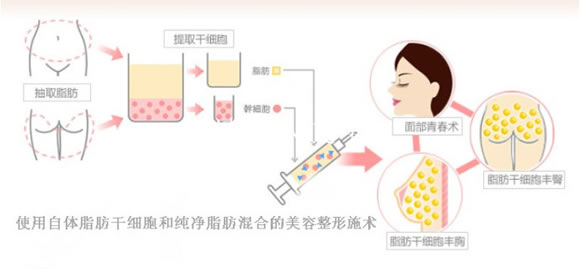 自体脂肪干细胞移植术大解析