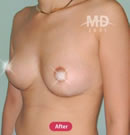 韩国MD整形外科巨乳缩小对比案例