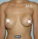乳房矫正整形术前后对比照片