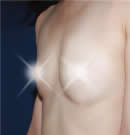 干细胞+脂肪移植胸部整形前后对比照片
