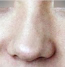 鼻子修复手术前后对比照片