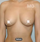 韩国MD整形外科假体隆胸术+乳房下垂悬吊术对比案例