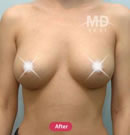 韩国MD整形外科假体隆胸术+乳房下垂悬吊术对比案例