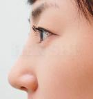 鹰钩鼻矫正术对比日记