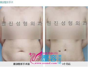 腰腹吸脂整形对比日记