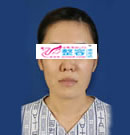 面部轮廓整形对比日记
