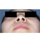 鼻部整形手术对比图