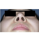 鼻部整形手术对比图
