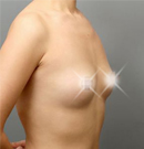 假体隆胸手术案例对比图