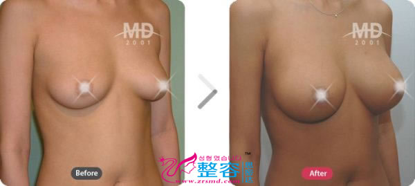 韩国MD整形外科假体隆胸术对比案例