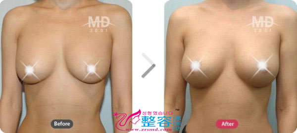韩国MD整形外科假体隆胸术+乳房下垂悬吊术对比日记
