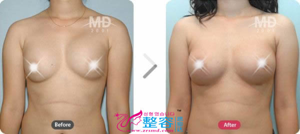 假体隆胸整形手术前后对比照片