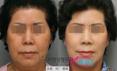面部抗衰老整形对比案例