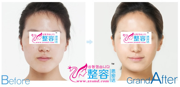 面部轮廓苹果肌（假体）手术 前后对比照片