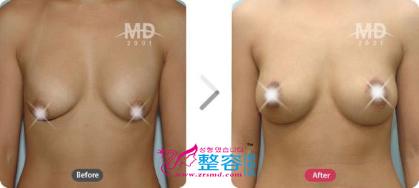 韩国MD整形外科假体隆胸+乳房下垂矫正术对比案例
