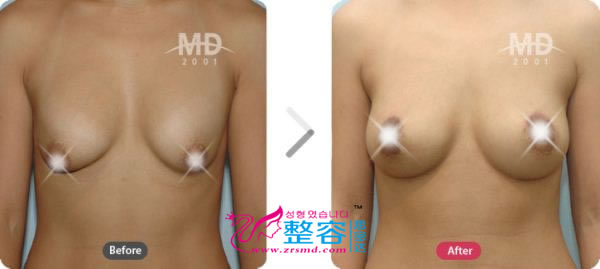韩国MD整形外科假体隆胸+乳房下垂矫正术对比日记