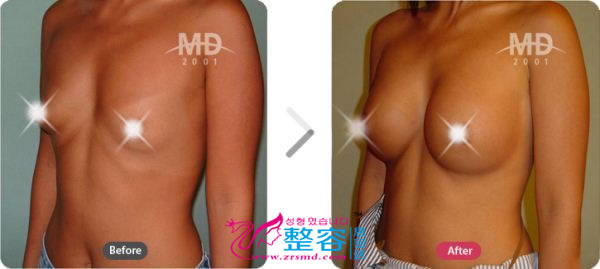 假体隆胸整形术前后对比照片
