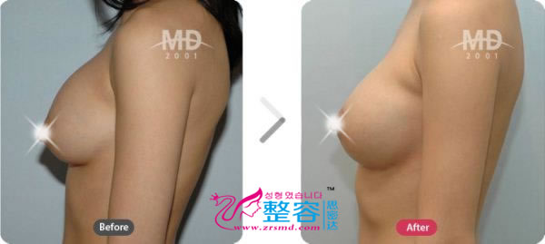 韩国MD整形外科假体隆胸对比案例