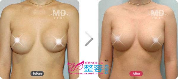 胸部整形手术前后对比照片