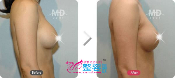 隆胸整形手术前后对比照片