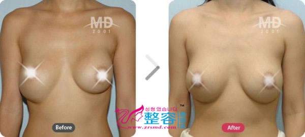 乳房矫正整形术前后对比照片