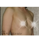 胸部整形手术对比图