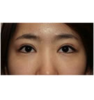 韩式双眼皮手术前后对比案例照片