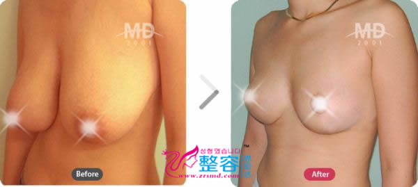 韩国MD整形外科巨乳缩小对比案例
