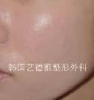 注射自体脂肪***移植配合激光治疗痘痕前后对比