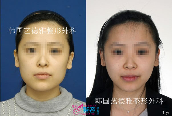 两颚手术对比日记