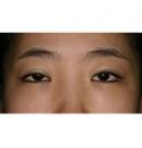 韩式双眼皮手术前后对比案例照片