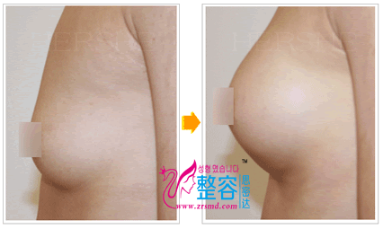 果冻义乳隆胸整形前后对比照片