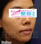 鼻部综合整形对比日记