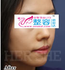 鼻部综合整形对比日记