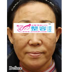 ***移植除皱手术对比日记