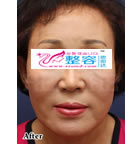 ***移植除皱手术对比日记