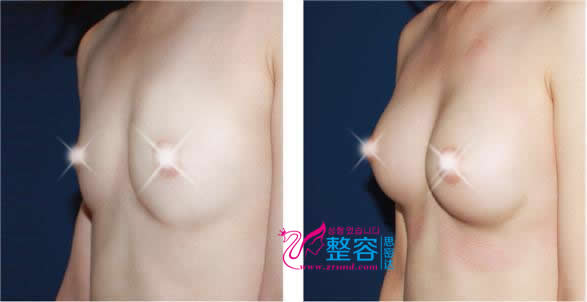 干细胞+脂肪移植胸部整形前后对比照片